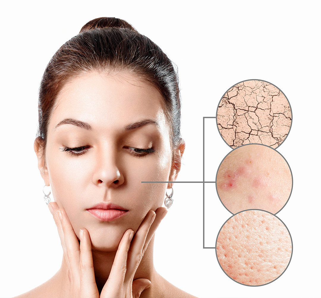 Hiperpigmentacija kože